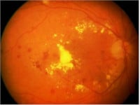 Retinopatía Diabética